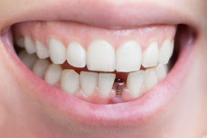 Bridges 300x200 - Purple Dental Care Bristol