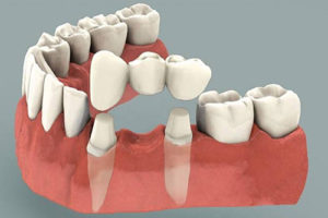 Crown Bridge Willow Springs Dental 300x200 - Purple Dental Care Bristol