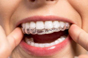 Invisalign Treatment