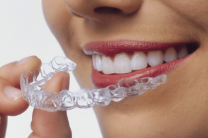 Invisalign in Bristol