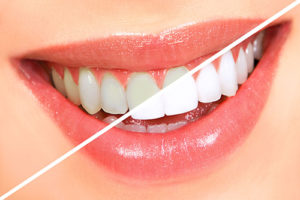 Teeth Whitening 300x200 - Purple Dental Care Bristol