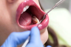 Wisdom Teeth 300x200 - Purple Dental Care Bristol