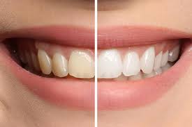 Teeth Whitening Offer