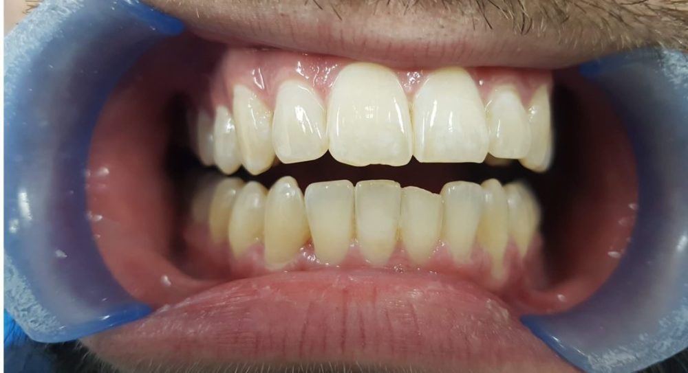 Invisalign after: straighter teeth