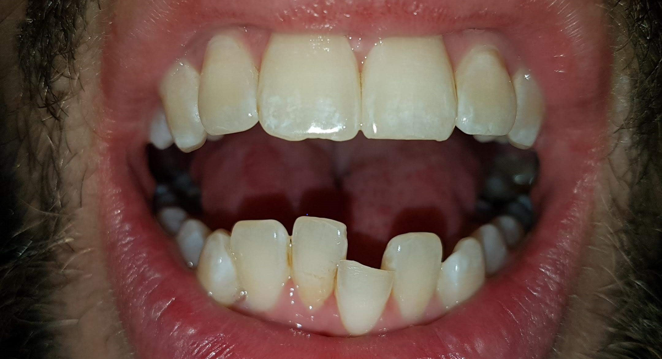 Invisalign before: crowded teeth