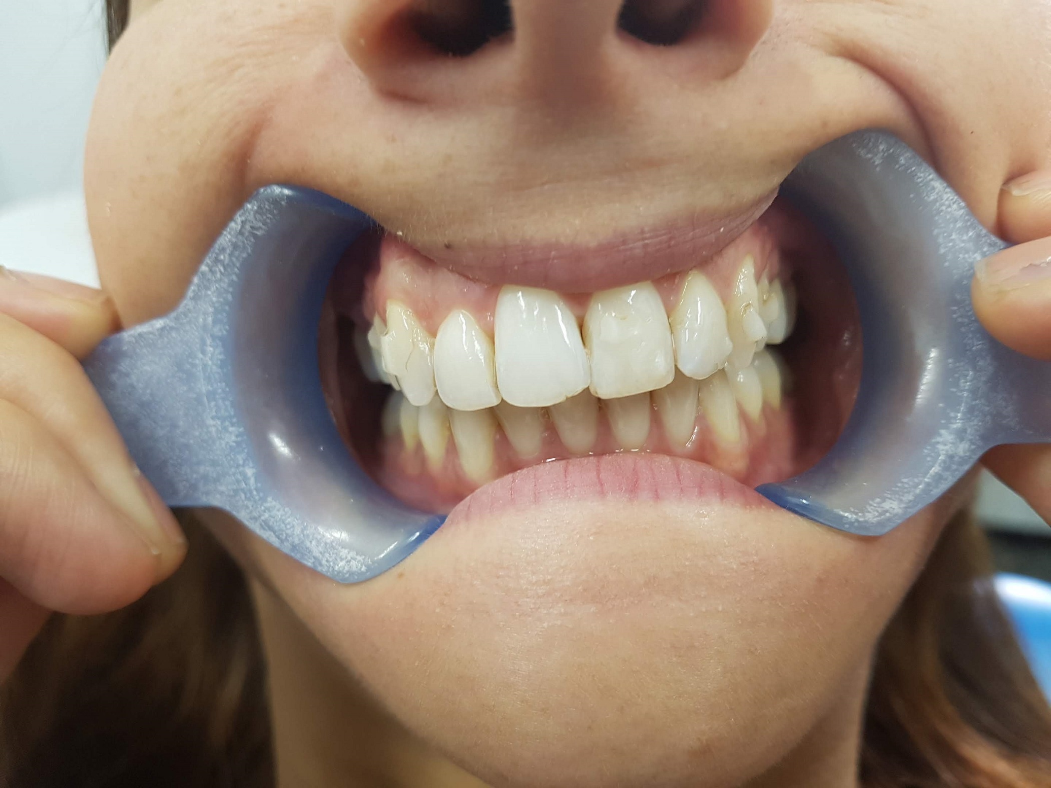 Invisalign after: closed gaps