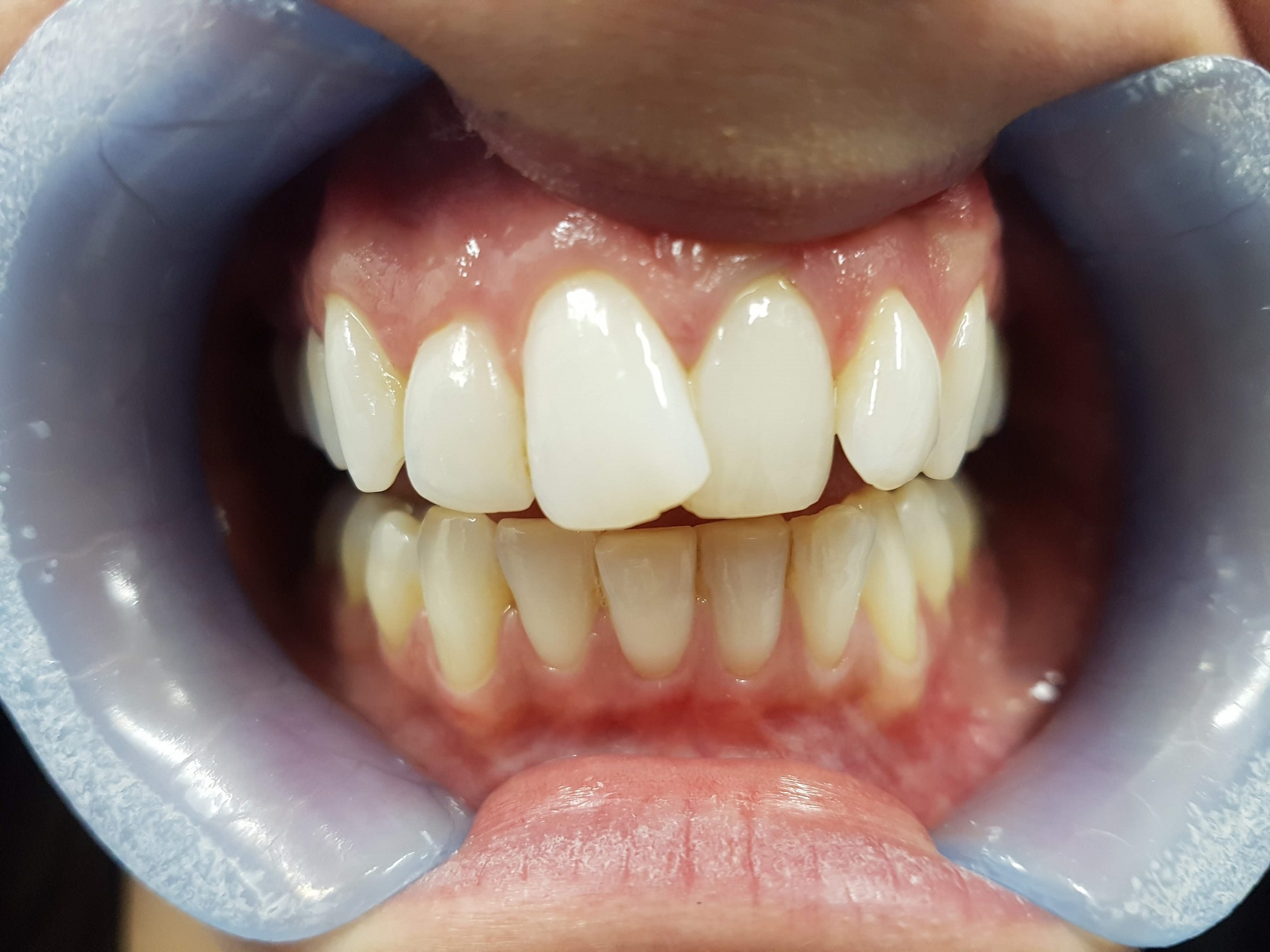 Invisalign before: spacing