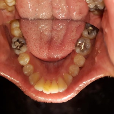 Invisalign after: improved alignment