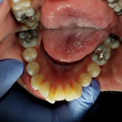 Invisalign before: bite and crowding