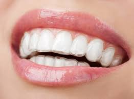 Invisalign clear aligner trays