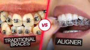 Close-up of an Invisalign clear aligner on teeth