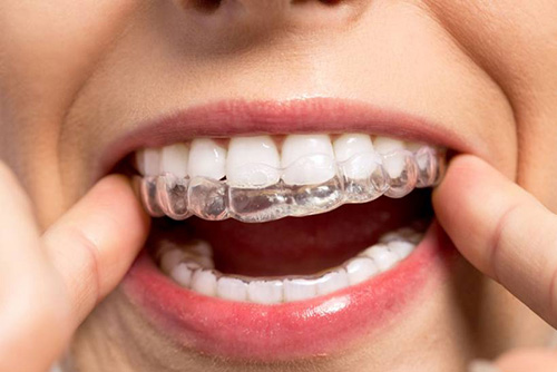 Invisalign clear aligner patient smiling at Purple Dental Care Bristol